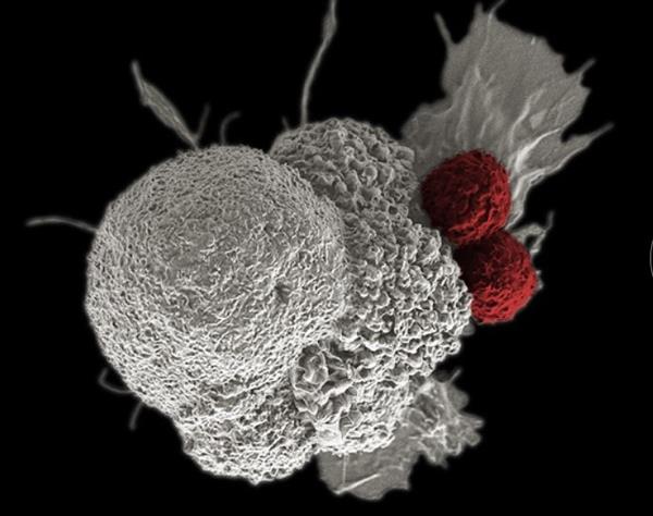 Hình ảnh tế bào ung thư dưới kính hiển vi